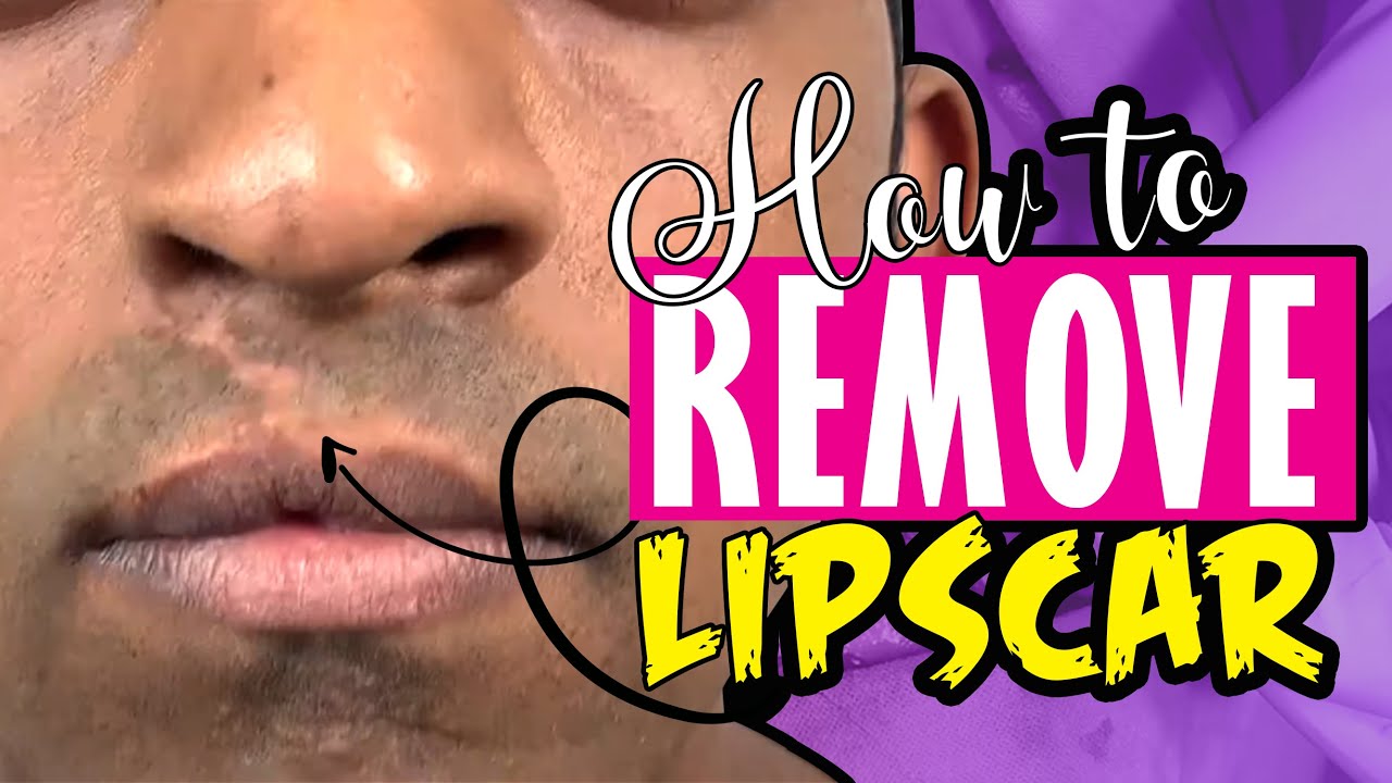 How to remove lip scar, improve shape and make in more luscious - How Tall Is Scar Lip? Rising Rap Star's Height Uncovered