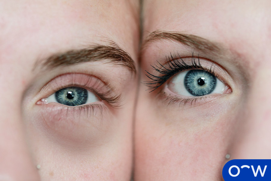 Puffy Eyes: Definition, Causes, Symptoms, and Treatment - How Tall Is Puffy Combs? Diddy’s Height Uncovered