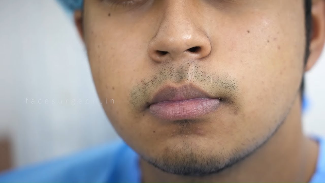 Remove Scars On Lips | Lipstutorial.org - How Tall Is Scar Lip? Rising Rap Star's Height Uncovered